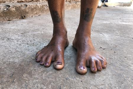 Swollen toes and ankle pain due to fluoride contamination in water made it difficult for Hrudamajhi to walk or sit properly.